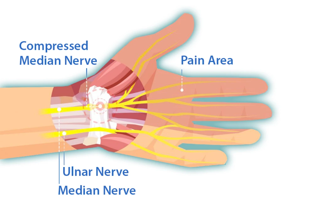 What is Carpal Tunnel Syndrome (CTS)